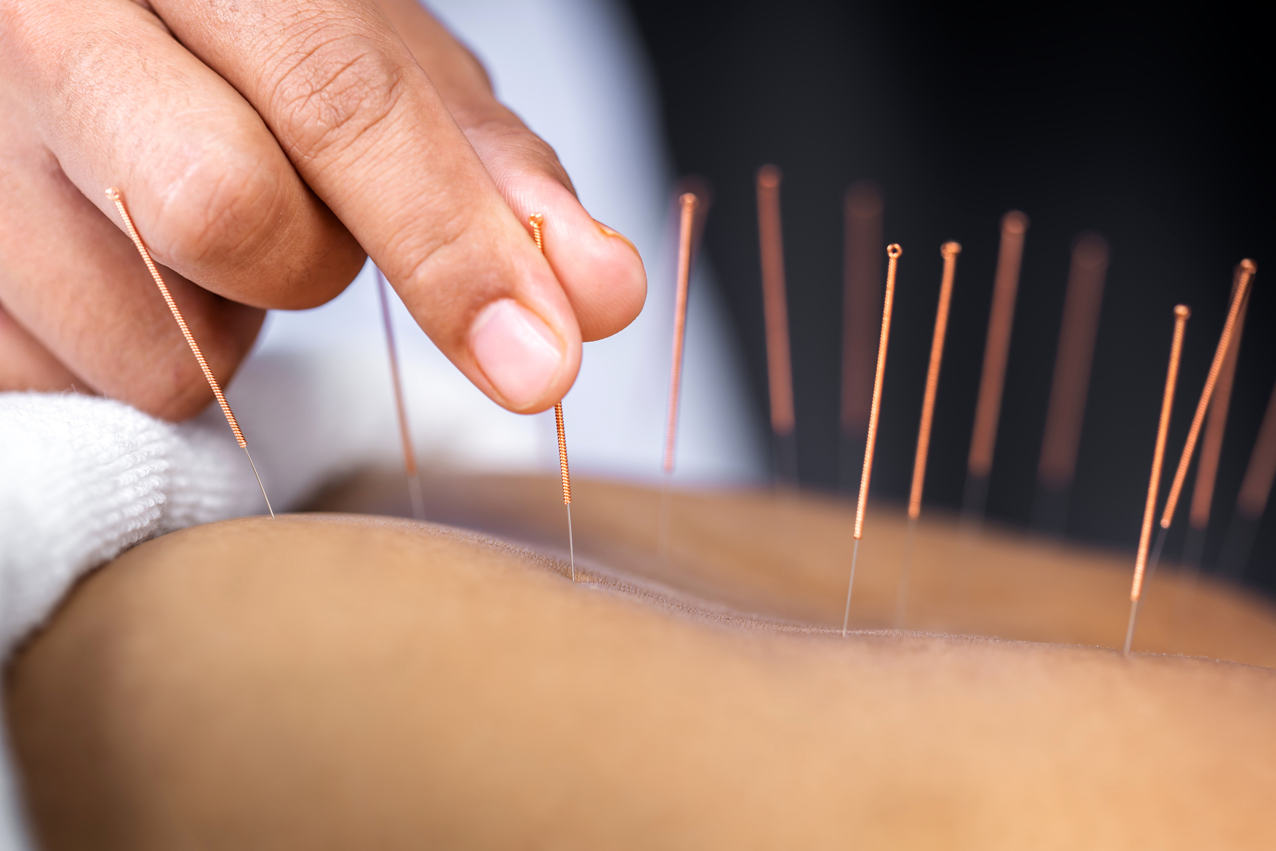 Close-up of senior female back with steel needles during procedu